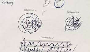 Image result for Essential Tremor