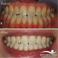 Pin On Teeth Whitening Columbia Missouri