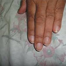 Chronic renal failure develops into end stage renal disease (esrd). Pdf Nail Changes In Chronic Renal Failure Patients Under Haemodialysis