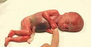 It is in regard to such children, who constitute 90% of abortion victims, that the myth persists that they are not really children at all. Rowan S Story World