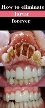 Learn more about removing teeth stains. Four Steps To Clean Tartar Oral Care Dental Health Care Cold Home Remedies