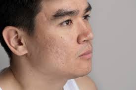 Mampu Mengatasi Pori Besar dan Bopeng? Apa perbedaan Transforming Scar  Resurfacing & Korean Platelet Rejuvenation?