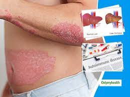 Primary Biliary Cirrhosis Pbc Signs Causes Diagnosis And Treatment Of This Autoimmune Disease Of Liver