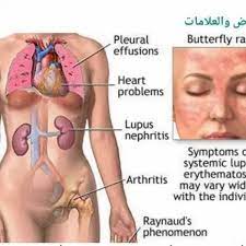 As a result of their lupus, many women have also sustained kidney damage, which can increase the risk for the fetus. Ø¯ÙƒØªÙˆØ± Ø§Ù„Ø§ Ø±Ø¨Ø¹ Ø§Ù„Ø°Ø¦Ø¨Ù‡ Ø§Ù„Ø­Ù…Ø±Ø§Ø¡ Sle Ø£Ø¹Ø±Ø§Ø¶