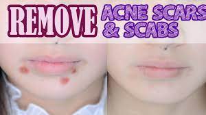How To: Remove Acne Scars & Scabs - Youtube