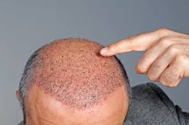 Dht resistant hair is taken from the back of the head and transferred to the front what can go wrong after a hair transplant surgery. Hair Transplants All Your Questions Answered