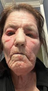 Apparently eating poison Ivy is the antidote for itchy nuts!