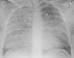 Image result for Pneumonia