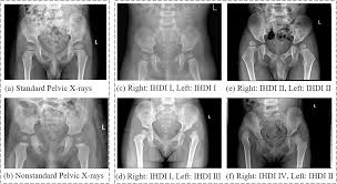 Image result for Hip XRay