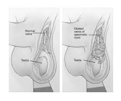 Image result for Varicocele