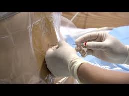 Generally speaking it can be 20g to 25g needle. Epidural Injection Procedure Youtube