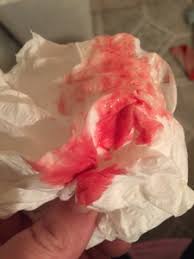 A pregnant woman can help. Tmi Pic Bleeding At 7 Weeks What To Expect General Pregnancy Forums What To Expect