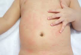 Sarpullido Por Calor En Los Bebes Causas Tratamiento Y Remedios Caseros