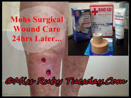 Gently clean the wound with water and then gently pat the wound dry. Miss Ruby Tuesday Mohs Surgical Wound Care 24hrs Later Youtube