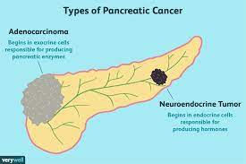 This alarming death rate is why raising awareness of this condition and diagnosing it early is … Pancreatic Cancer Coping Support And Living Well