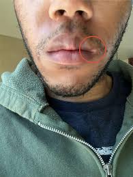 Image result for Postinflammatory Hypopigmentation