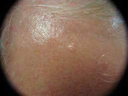 Image result for Sebaceous Hyperplasia