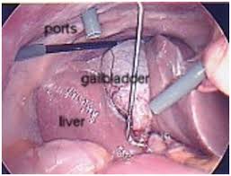 Gallbladder specialists perform surgery to remove the gallbladder (cholecystectomy) which is the only way to cure gallstones. Gallbladder Surgery India India Cost Laparoscopic Gallbladder Surgery
