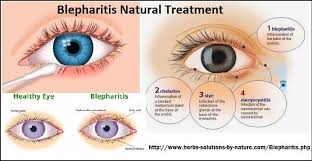 4 Home Base Natural Treatments For Blepharitis Blepharitis Natural Treatments Blepharitis Treatment
