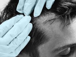 Image result for Auspitz Sign