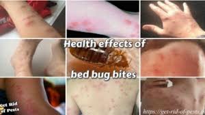 The bites may be mistaken for a rash of another cause. What Do Bedbug Bites Look Like Signs Of Bed Bug Bites On Skin Health