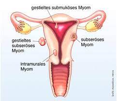 Ancak abortus (düşük) insidansı 2 misli artmıştır, erken gebelik kanamalarına neden olabilir. Myom Sprechstunde