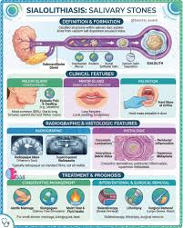 Image result for Sialolithiasis