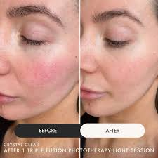 Triple Fusion Phototherapy