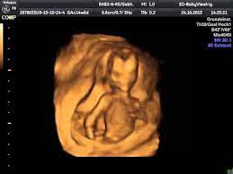 3d Baby Baby 14 6 Ssw Tanz Mit Der Nabelschnur 3d 4d Baby Ultraschal Sitzung Bei Www 3d Baby Com Youtube