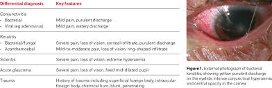 Image result for Acute Red Eye