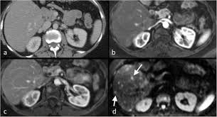 I was told that a bone scan is often used for diagnosis whereas ct scans can be used for follow up scans. Imaging Diagnosis Of Metastatic Breast Cancer Insights Into Imaging Full Text