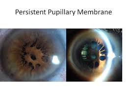 Name Vonda Cross Comt Cra Description Ophthalmology Ophthalmicphotography Slitlamp Photo Persistent Pupillary Me Eye Facts Eye Health Laser Eye Surgery