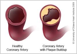 Coronary Artery Disease Atherosclerosis Ottawa Heart Institute