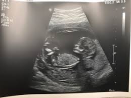 What Is Considered Big Subchorionic Hematoma Forums
