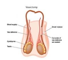 Masa Escrotal O Granuloma Despues De La Vasectomia New York Vasectomy Center