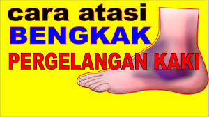Penyebab kaki bengkak selanjutnya yaitu gagal ginjal. Kaki Bengkak Selepas Jatuh Di Parit Berita 2021