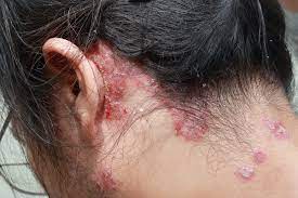 Some people experience hair loss in bald patches. Psoriasis Psoriatic Arthritis And Hair Loss Causes And Treatments