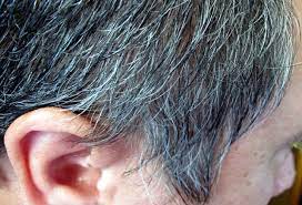 This can look like sudden graying. What Causes Premature Graying In Hair Short Hills Dermatology