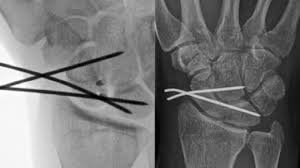 Image result for Scapholunate Dislocation