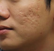 Cara menghilangkan jerawat dengan menggunakan lidah buaya untuk menghilangkan jerawat adalah kerok gel lidah buaya secara langsung dengan menggunakan sendok. 7 Petua Hilangkan Parut Jerawat Di Muka Cara Tradisional