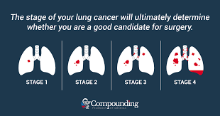 November is lung cancer awareness month, and one woman is sharing her story to raise awareness. What Does It Mean If My Lung Cancer Is Inoperable
