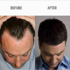 Many women experience thinning hair and hair loss during the menopause transition because of the fluctuation of hormones, specifically estrogen. 17alpha Estradiol Cas 57 91 0 For Female Sex Healthy Hormones For Hair Loss China 57 91 0 Treating Hair Loss Made In China Com