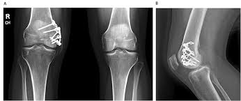 Image result for Lateral Condyle Fracture