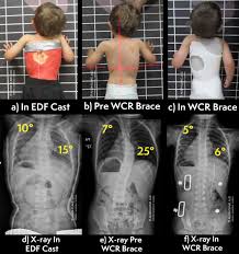 Infantile Idiopathic Scoliosis​ - Align Clinic