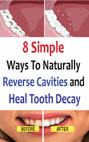 Tooth decay occurs when foods containing carbohydrates (sugars and starches) such as milk, pop, raisins, cakes or so how can you reverse cavities naturally?of course it's important to brush and floss daily, but there are additional ways you can reverse your cavities naturally whilst also. 8 Simple Ways To Naturally Reverse Cavities And Heal Tooth Decay Dental Decay Reverse Cavities Tooth Decay