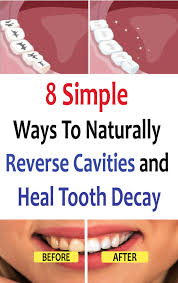 However, it's been proven that there are ways to reverse cavities naturally. 8 Simple Ways To Naturally Reverse Cavities And Heal Tooth Decay Reverse Cavities Dental Decay Tooth Decay