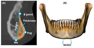 Variation in Chin and Mandibular Symphysis Size and Shape in Males and  Females: A CT-Based Study