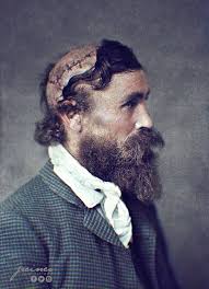 Survival story of a scalped man in 1864