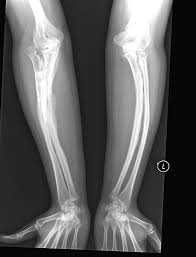 Brittle Bone Disease Penyakit