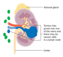 The dough can be based on bread, flour or potatoes, and may be filled with meat, fish, cheese, vegetables, fruits or sweets. Kidney Cancer Treatment In India Kidney Tumor Surgery Cost In India